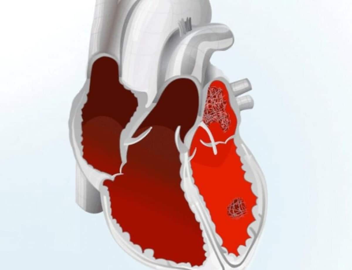 Thromboseentstehung im Herz