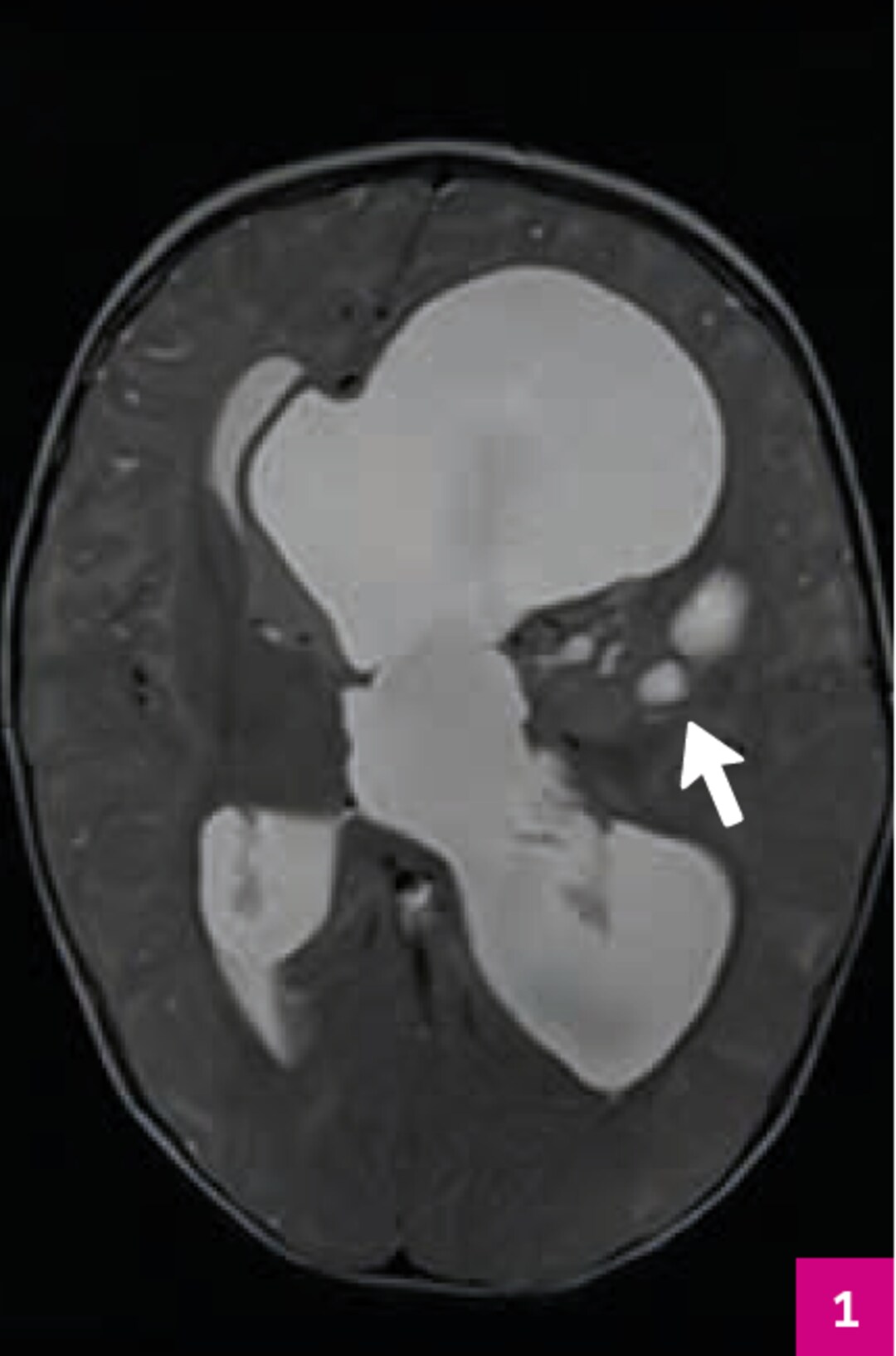 Tra T2 mit inhomogener z.T. hyperintenser und z.T. hirnparenchymisointenser Raumforderung links intrahemisphäriell und intraventrikulär. Ausgeprägte Mittellinienverlagerung nach rechts und kaum abgrenzbare äußere Liquorräume.