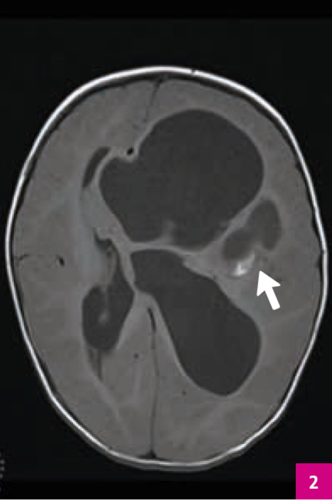 Tra T1 mit inhomogener z.T. hyperintenser und z.T. hypointenser Raumforderung links intrahemisphäriell und intraventrikulär. Ausgeprägte Mittellinienverlagerung nach rechts und kaum abgrenzbare äußere Liquorräume.