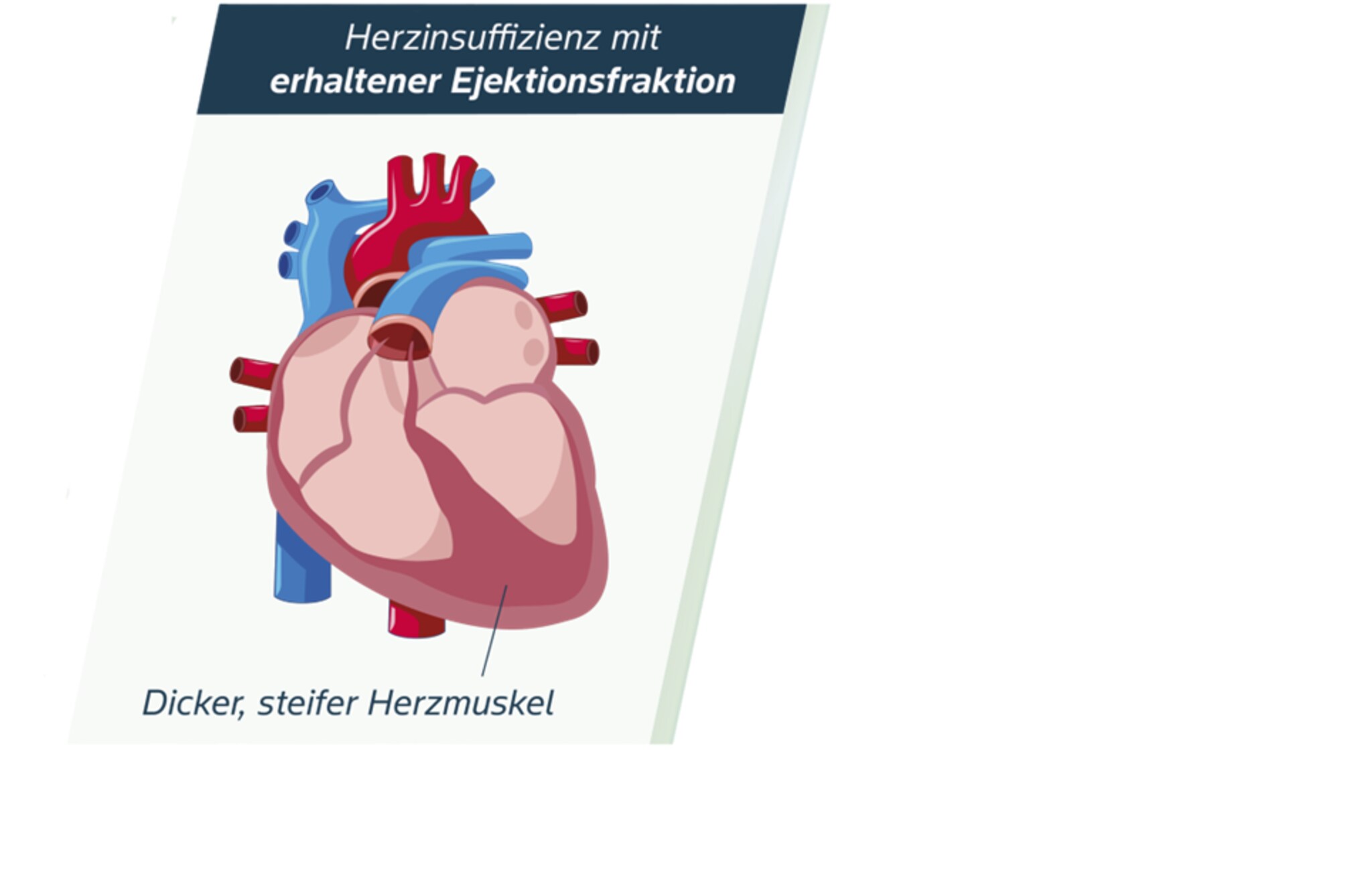 HFpEF Abbildung