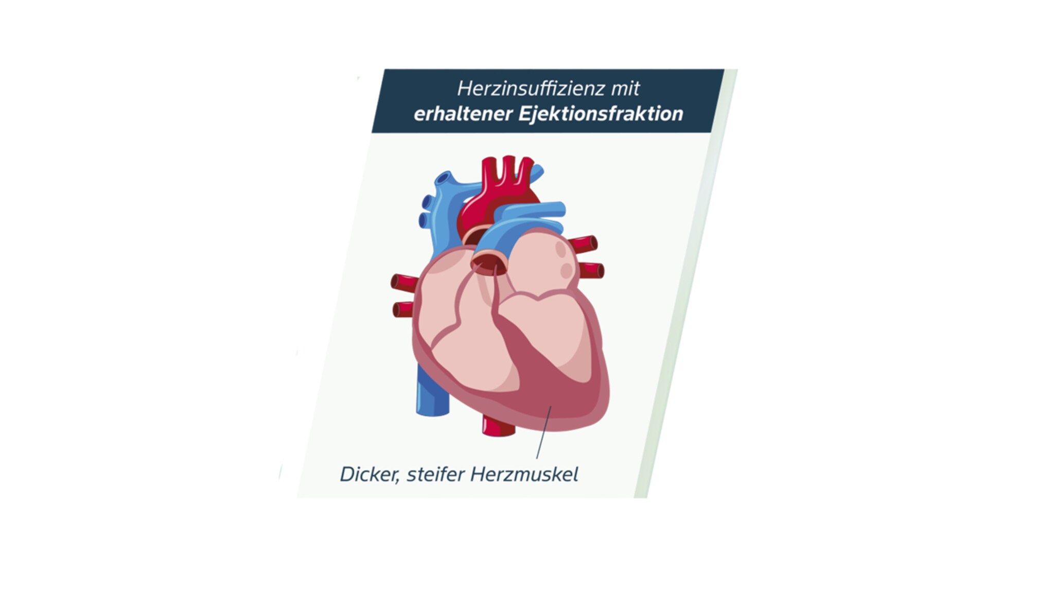 HFpEF Abbildung