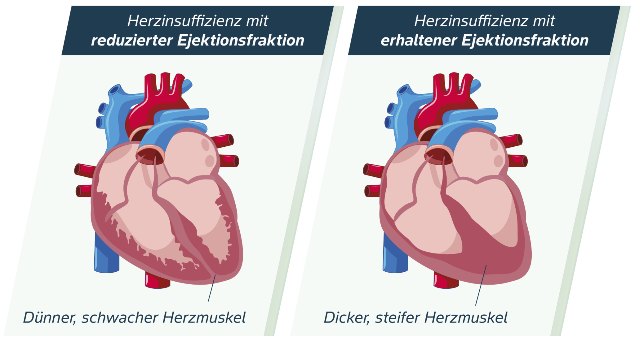 HFpEF und HFrEF Vergleich